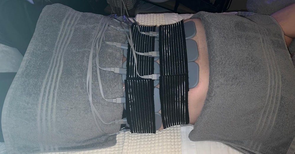 EMS body contouring straps applied to the abdomen